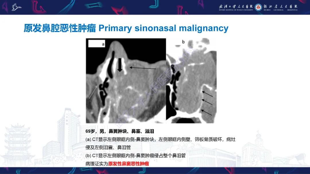 影像PPT - 【PPT】泪道病变影像诊断-39