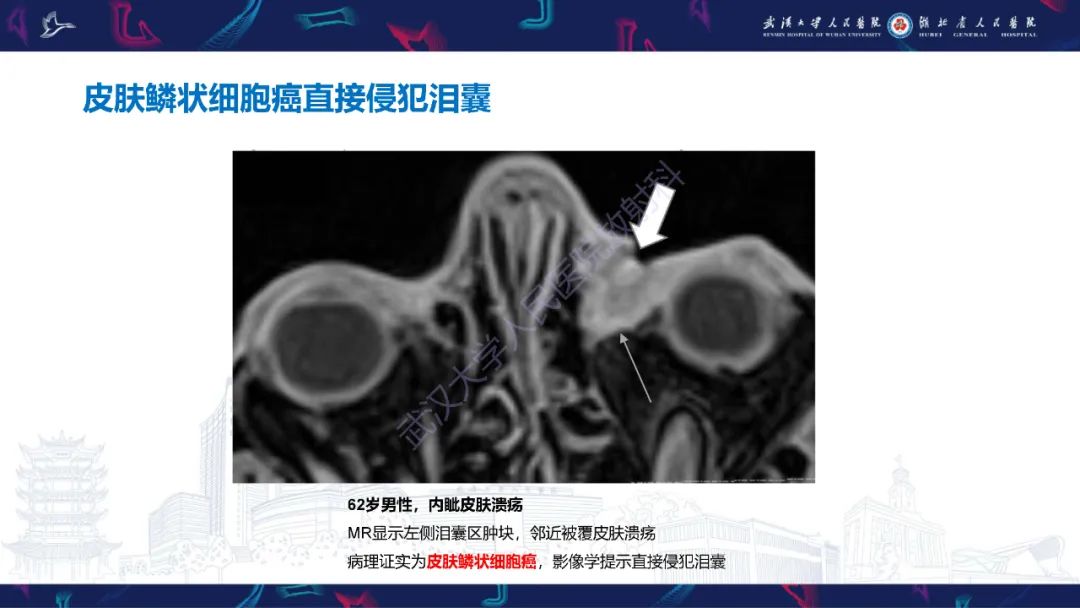 影像PPT - 【PPT】泪道病变影像诊断-37