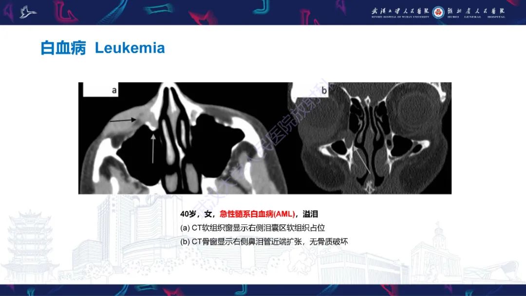 影像PPT - 【PPT】泪道病变影像诊断-40