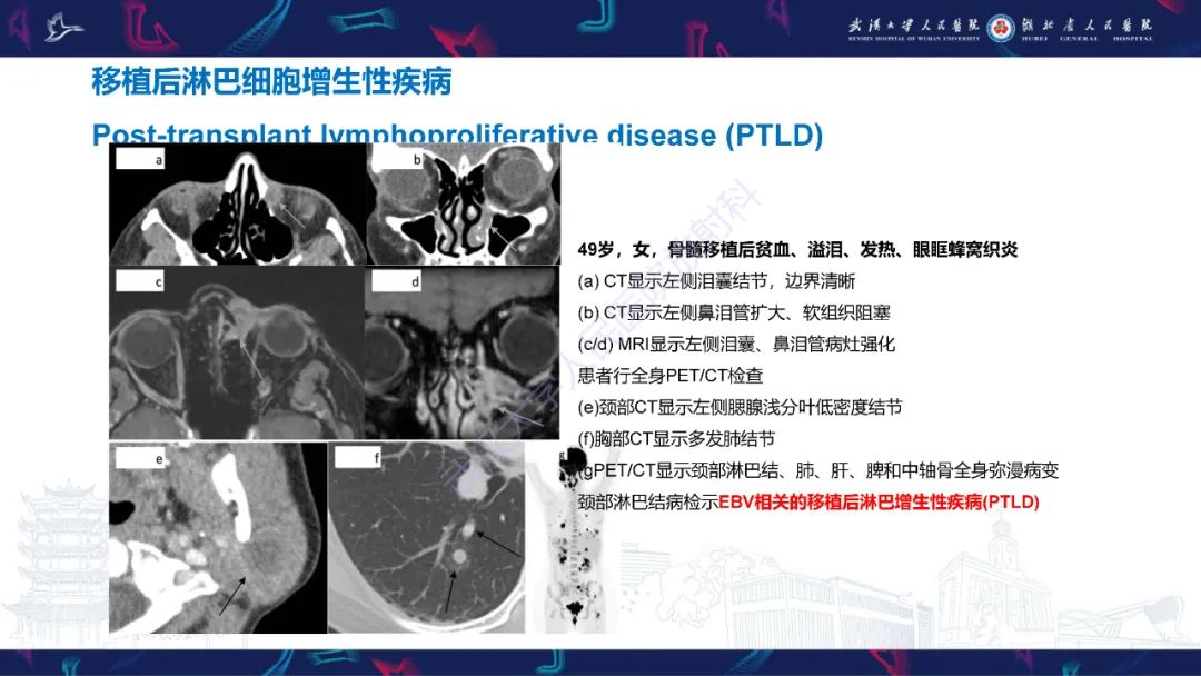 影像PPT - 【PPT】泪道病变影像诊断-41