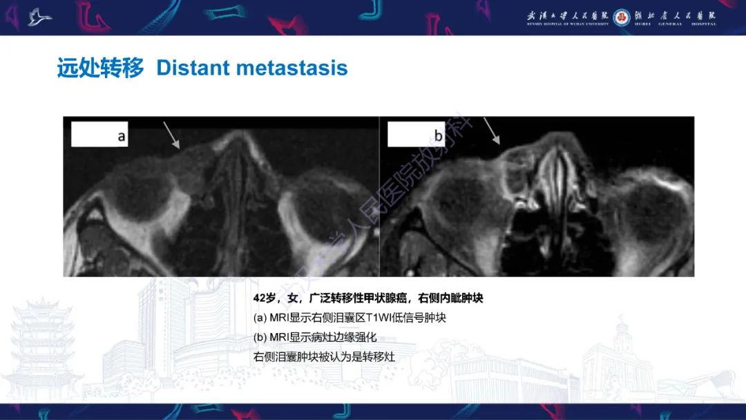 影像PPT - 【PPT】泪道病变影像诊断-42