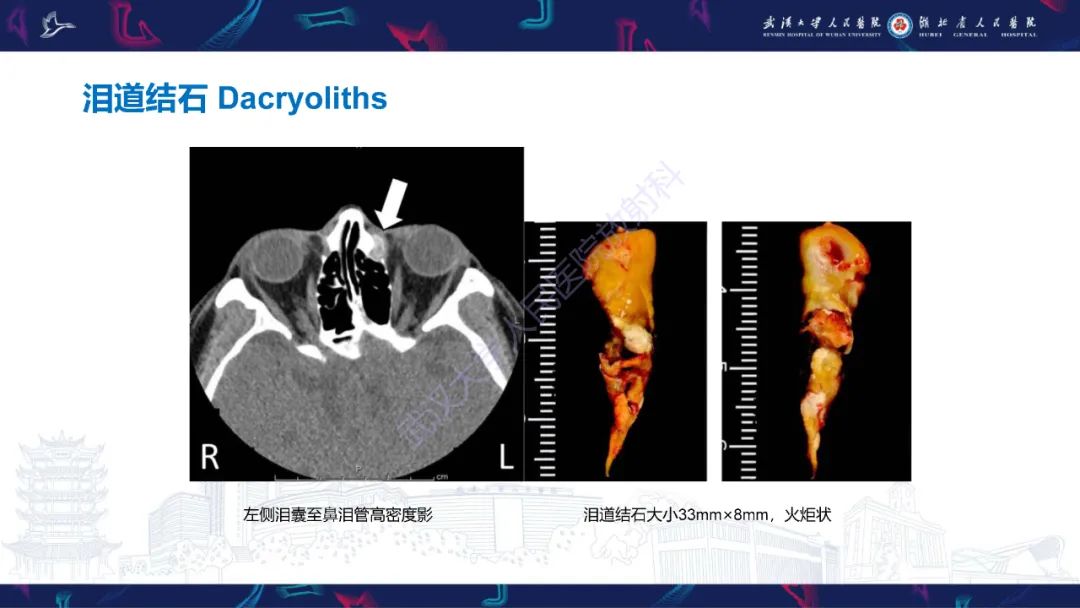 影像PPT - 【PPT】泪道病变影像诊断-43
