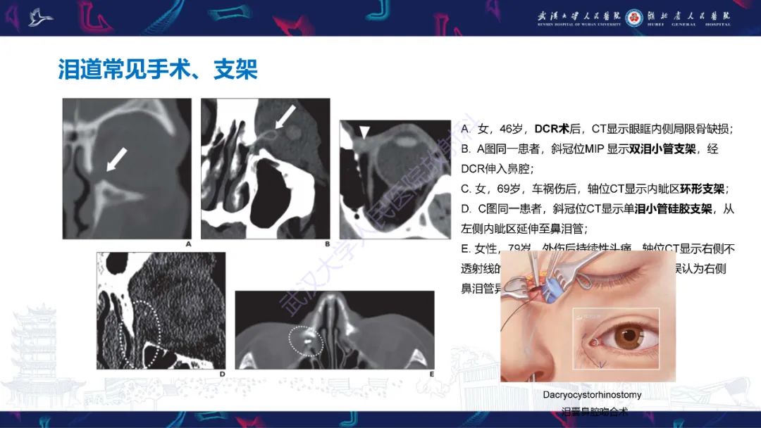 影像PPT - 【PPT】泪道病变影像诊断-44