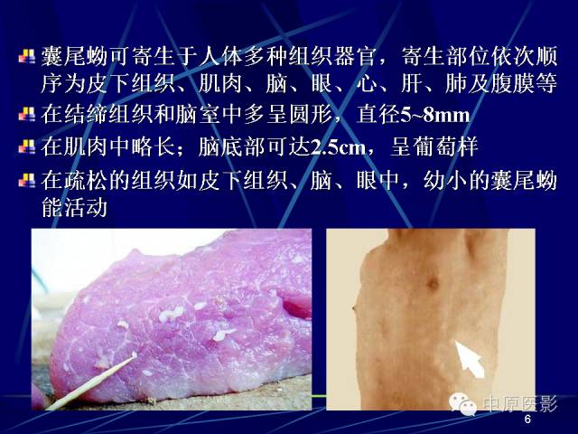 影像PPT - 【PPT】脑囊虫病的影像学诊断-5