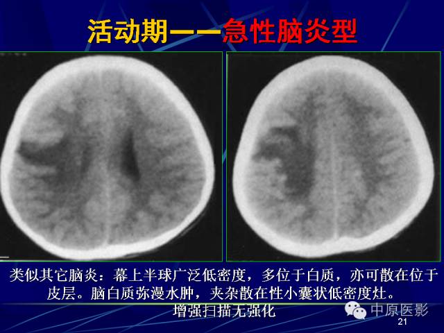 影像PPT - 【PPT】脑囊虫病的影像学诊断-20
