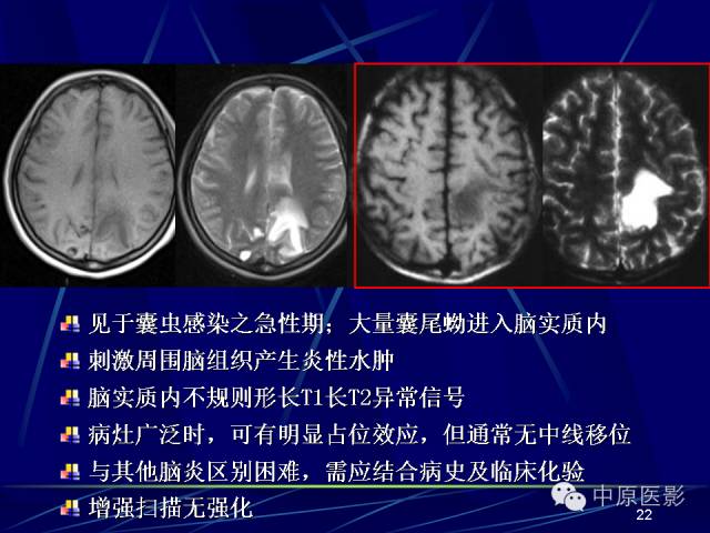 影像PPT - 【PPT】脑囊虫病的影像学诊断-21