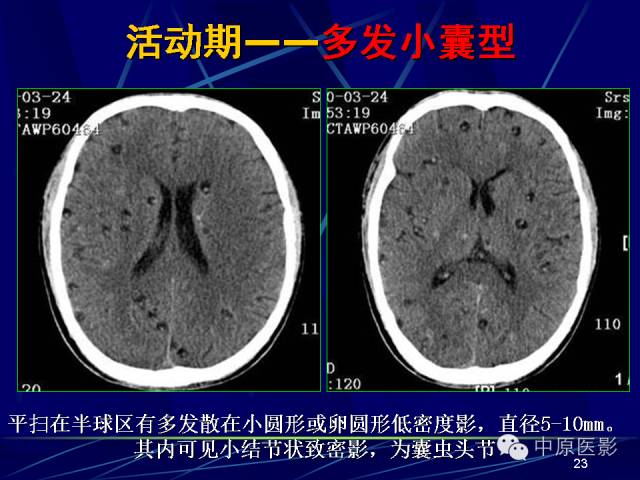 影像PPT - 【PPT】脑囊虫病的影像学诊断-22