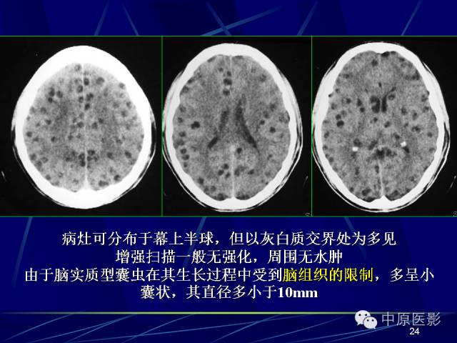 影像PPT - 【PPT】脑囊虫病的影像学诊断-23