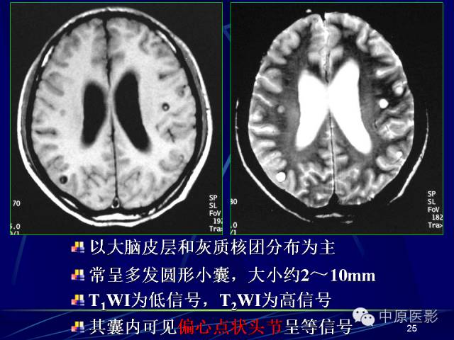 影像PPT - 【PPT】脑囊虫病的影像学诊断-24