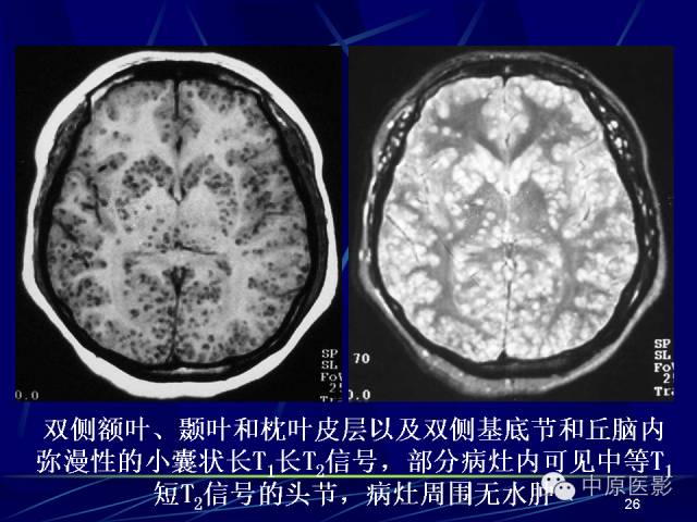 影像PPT - 【PPT】脑囊虫病的影像学诊断-25