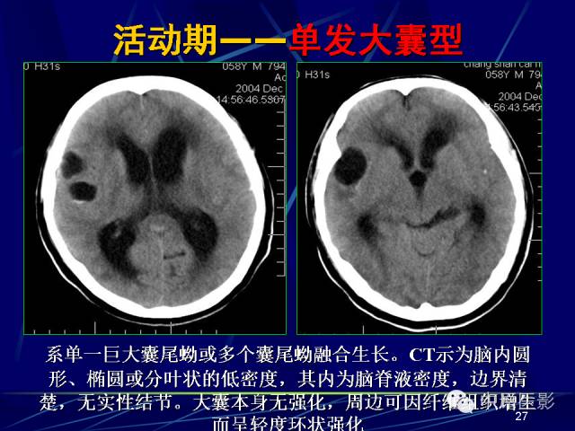 影像PPT - 【PPT】脑囊虫病的影像学诊断-26