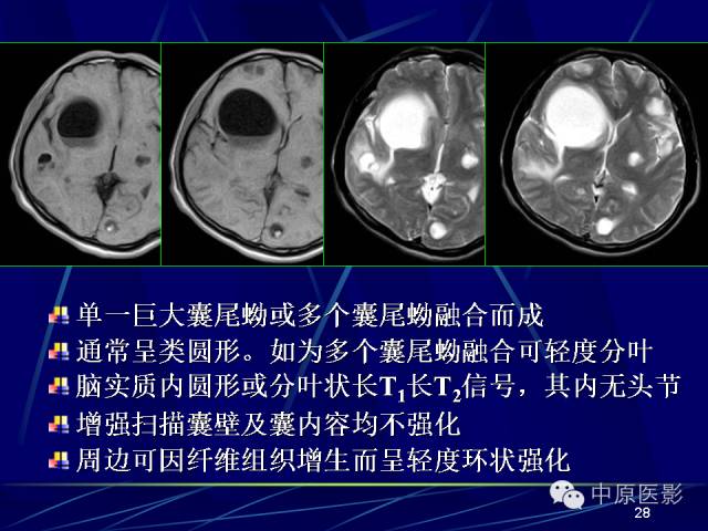 影像PPT - 【PPT】脑囊虫病的影像学诊断-27