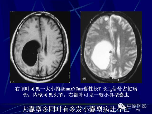 影像PPT - 【PPT】脑囊虫病的影像学诊断-28