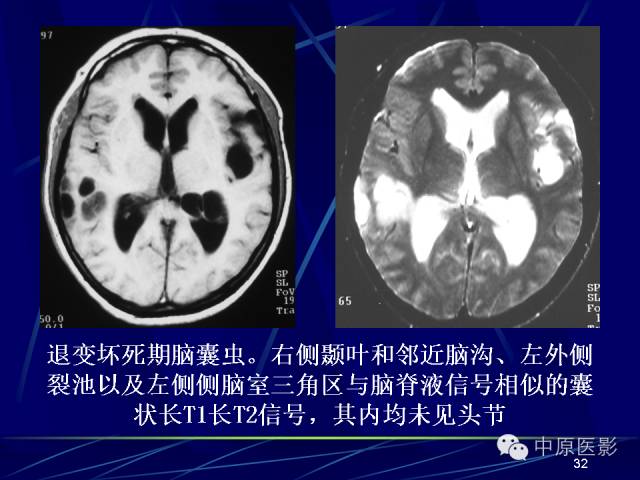 影像PPT - 【PPT】脑囊虫病的影像学诊断-31