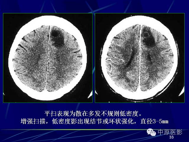 影像PPT - 【PPT】脑囊虫病的影像学诊断-32