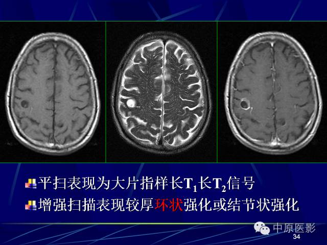 影像PPT - 【PPT】脑囊虫病的影像学诊断-33