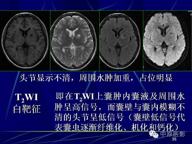 影像PPT - 【PPT】脑囊虫病的影像学诊断-34