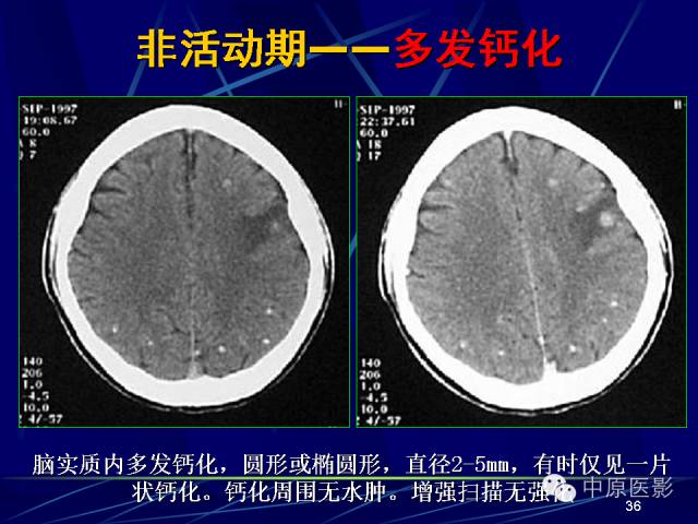 影像PPT - 【PPT】脑囊虫病的影像学诊断-35