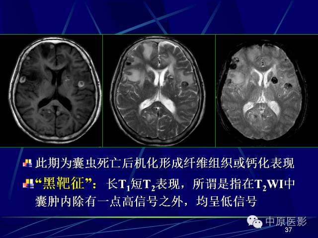 影像PPT - 【PPT】脑囊虫病的影像学诊断-36