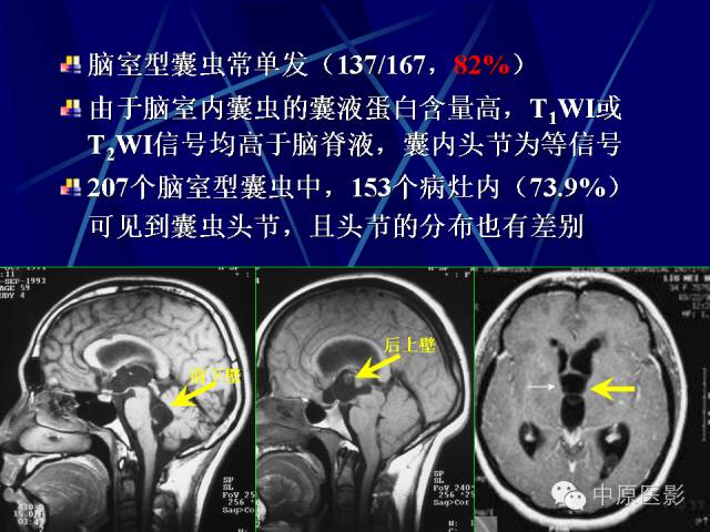 影像PPT - 【PPT】脑囊虫病的影像学诊断-39