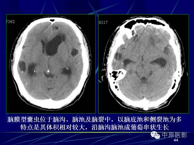 影像PPT - 【PPT】脑囊虫病的影像学诊断-43