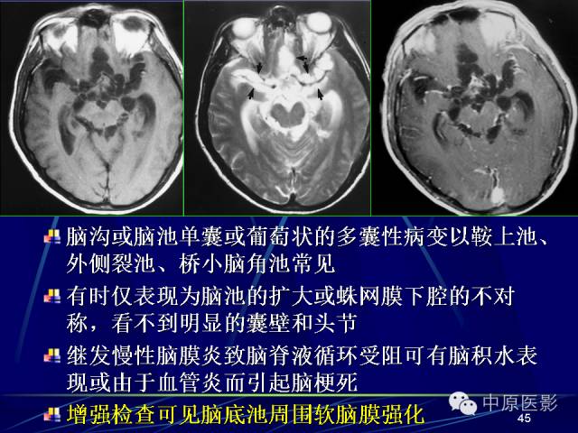 影像PPT - 【PPT】脑囊虫病的影像学诊断-44