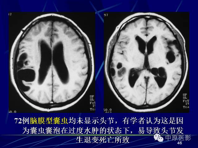 影像PPT - 【PPT】脑囊虫病的影像学诊断-45