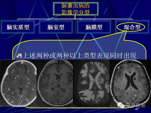 影像PPT - 【PPT】脑囊虫病的影像学诊断-46
