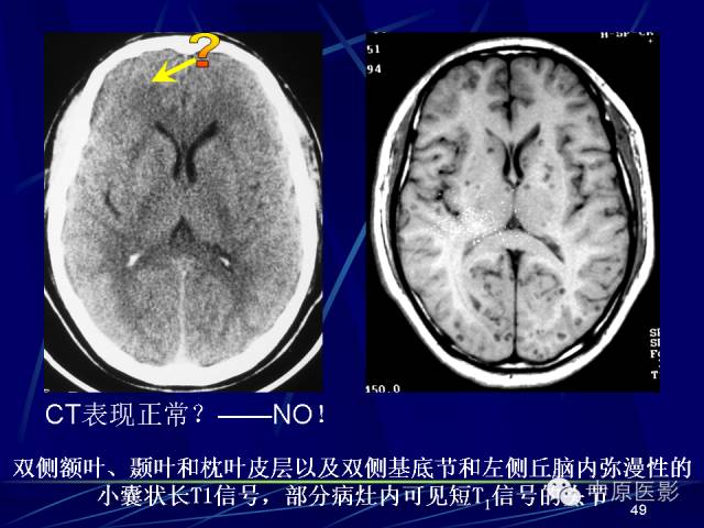 影像PPT - 【PPT】脑囊虫病的影像学诊断-48