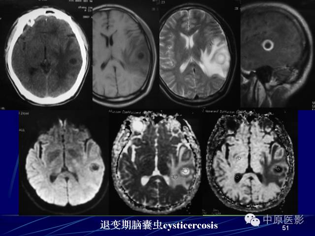 影像PPT - 【PPT】脑囊虫病的影像学诊断-50