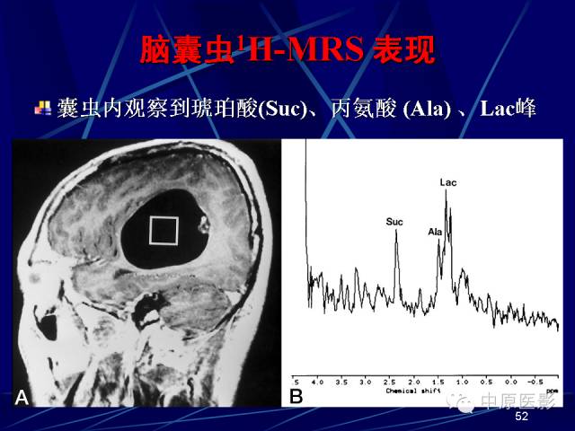 影像PPT - 【PPT】脑囊虫病的影像学诊断-51