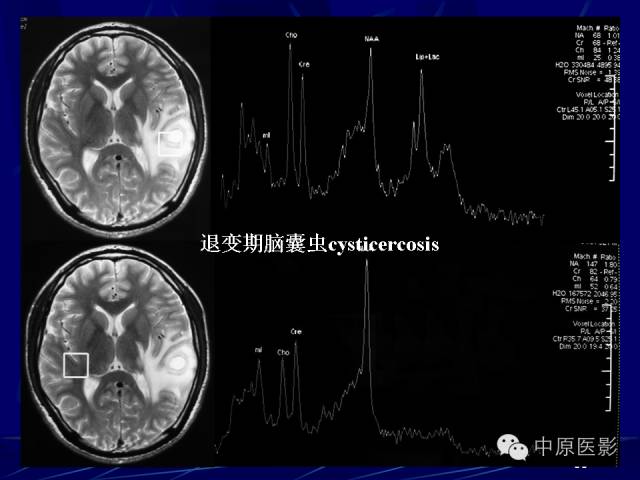 影像PPT - 【PPT】脑囊虫病的影像学诊断-52