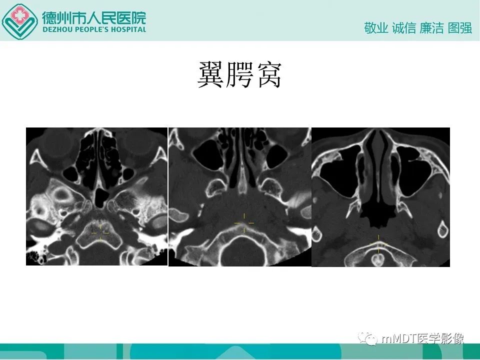 影像PPT - 【PPT】小小孔穴连洞天——翼腭窝的颅底交通-16