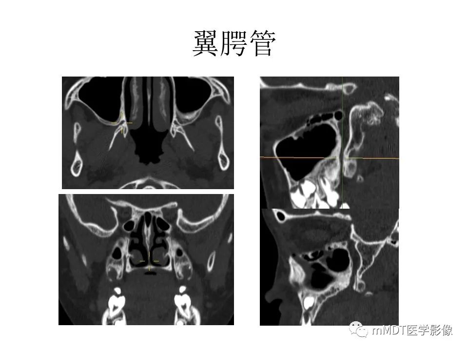 影像PPT - 【PPT】小小孔穴连洞天——翼腭窝的颅底交通-17