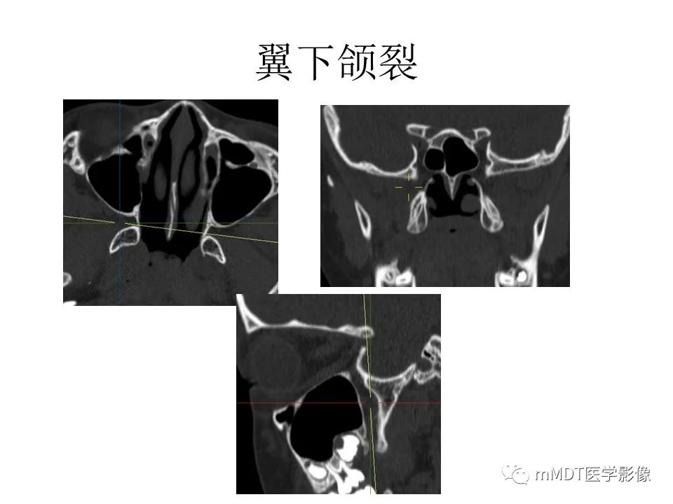 影像PPT - 【PPT】小小孔穴连洞天——翼腭窝的颅底交通-18