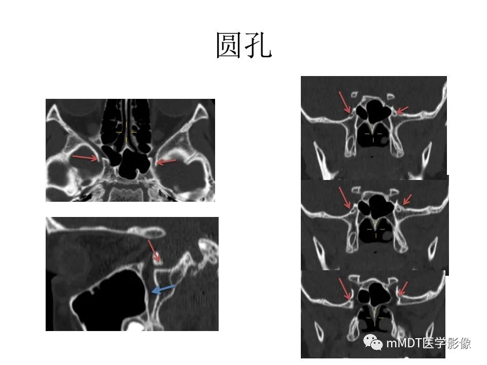 影像PPT - 【PPT】小小孔穴连洞天——翼腭窝的颅底交通-20