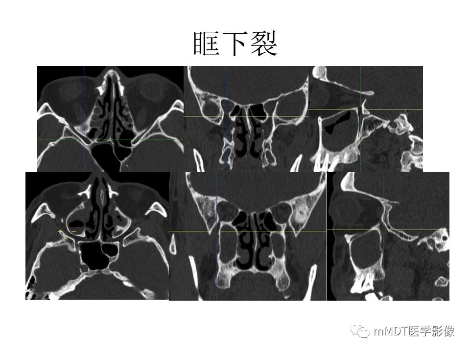 影像PPT - 【PPT】小小孔穴连洞天——翼腭窝的颅底交通-21