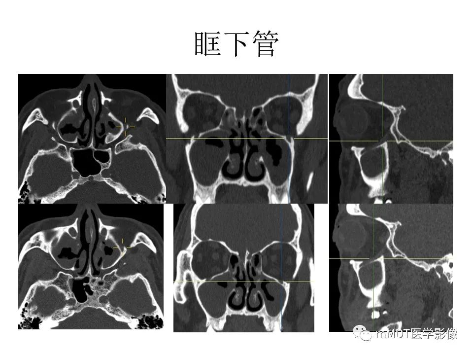 影像PPT - 【PPT】小小孔穴连洞天——翼腭窝的颅底交通-22