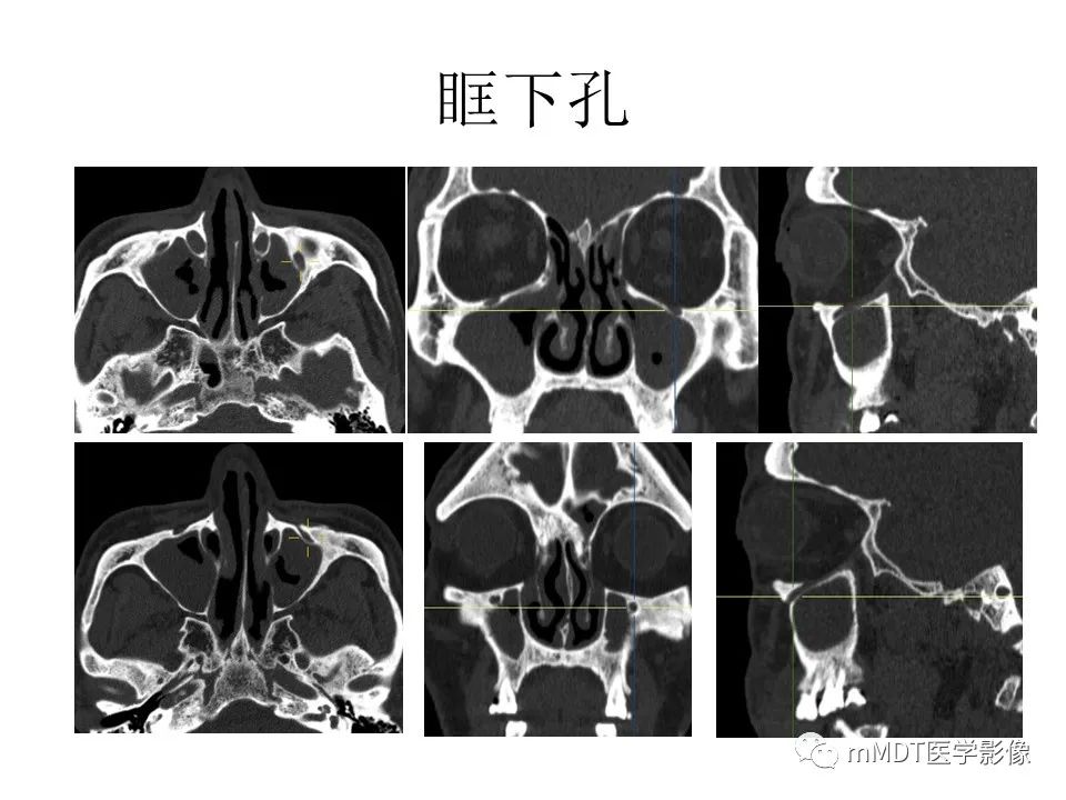 影像PPT - 【PPT】小小孔穴连洞天——翼腭窝的颅底交通-23