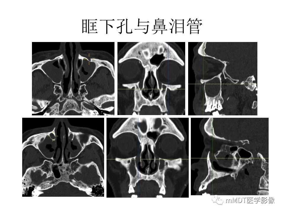 影像PPT - 【PPT】小小孔穴连洞天——翼腭窝的颅底交通-24