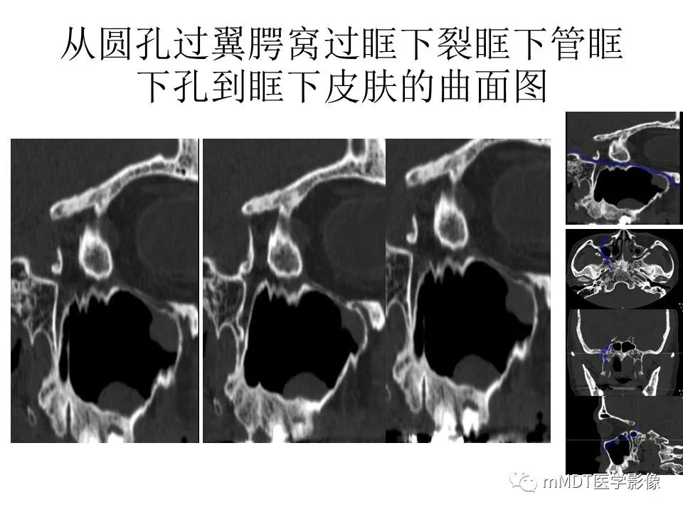 影像PPT - 【PPT】小小孔穴连洞天——翼腭窝的颅底交通-25