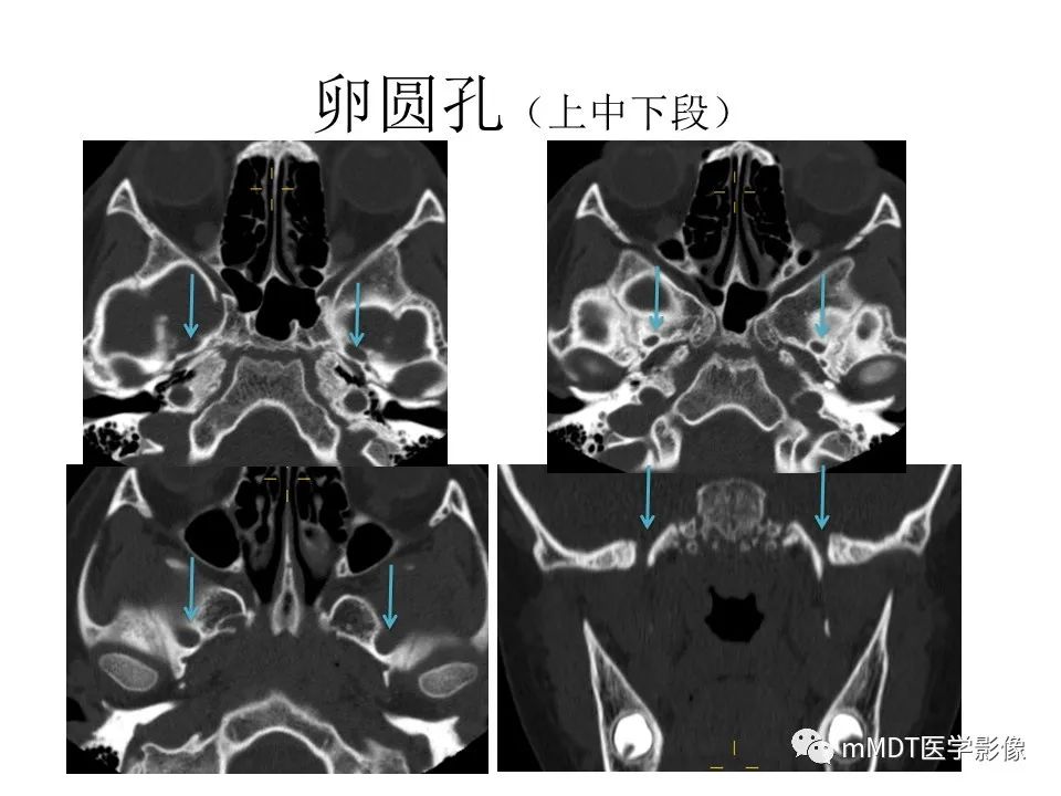 影像PPT - 【PPT】小小孔穴连洞天——翼腭窝的颅底交通-28