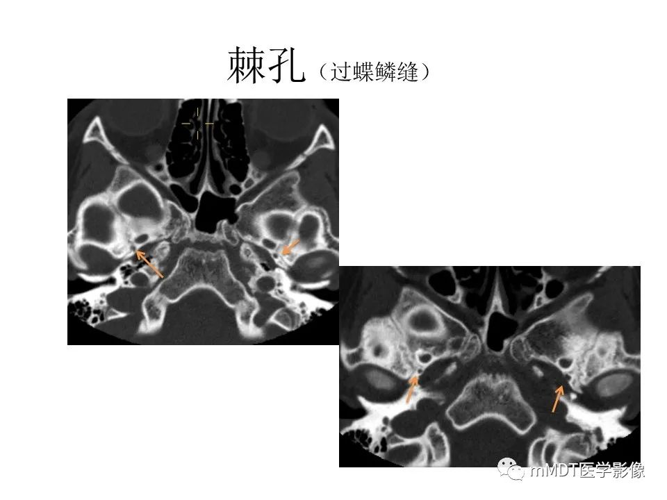 影像PPT - 【PPT】小小孔穴连洞天——翼腭窝的颅底交通-30