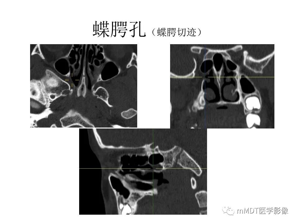影像PPT - 【PPT】小小孔穴连洞天——翼腭窝的颅底交通-32