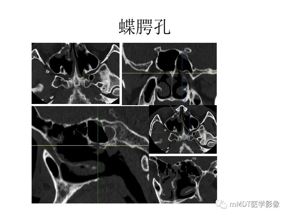 影像PPT - 【PPT】小小孔穴连洞天——翼腭窝的颅底交通-33