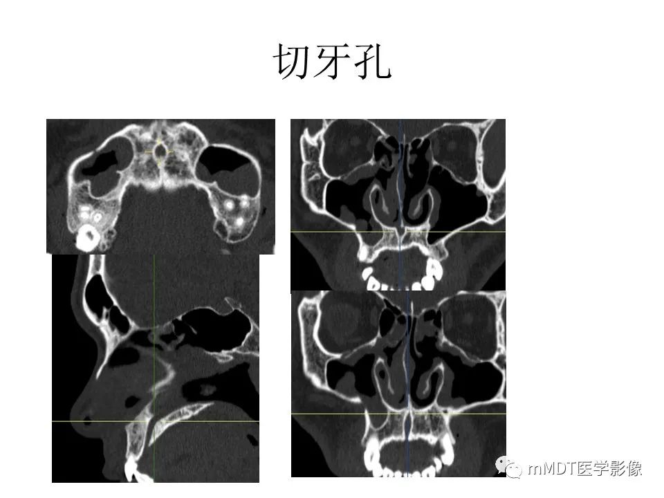 影像PPT - 【PPT】小小孔穴连洞天——翼腭窝的颅底交通-35