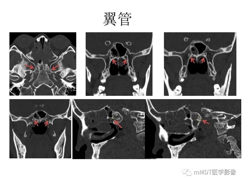 影像PPT - 【PPT】小小孔穴连洞天——翼腭窝的颅底交通-36