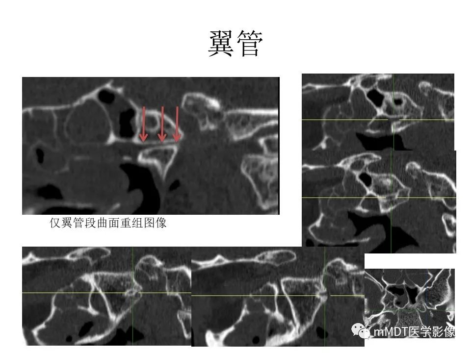 影像PPT - 【PPT】小小孔穴连洞天——翼腭窝的颅底交通-37