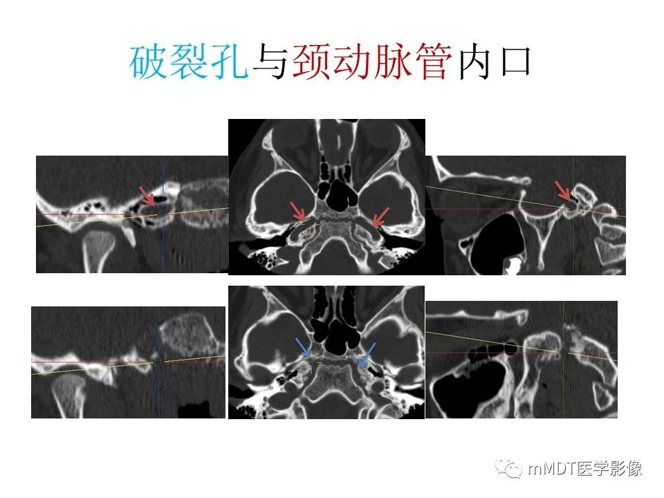 影像PPT - 【PPT】小小孔穴连洞天——翼腭窝的颅底交通-38