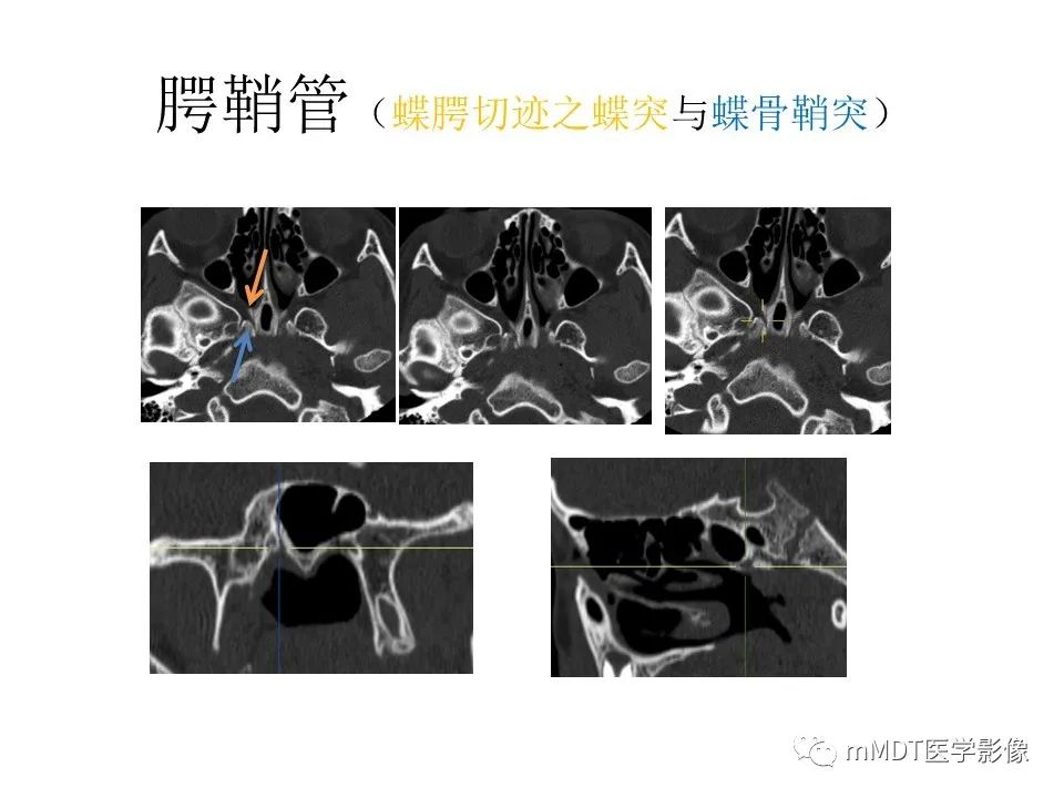影像PPT - 【PPT】小小孔穴连洞天——翼腭窝的颅底交通-40